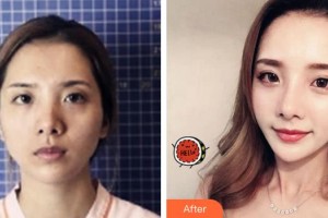 三明市第五醫(yī)院美容整形科許文整形價(jià)格表附鼻部綜合案例展示