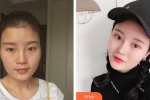 三明歐菲整形美容醫(yī)院何強(qiáng)整形價(jià)格表附膨體隆鼻案例展示