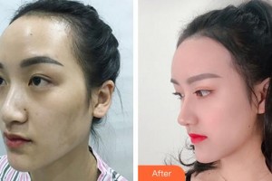 三明萬國美萊醫(yī)療美容外科門診部魏美蓮整形價(jià)格表附鼻部手術(shù)+大腿吸脂+脂肪豐胸案例展示