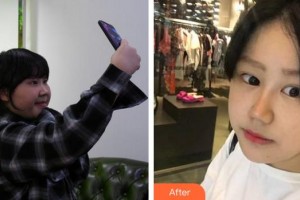 三明市中西醫(yī)結(jié)合醫(yī)院眼科張志廣整形價(jià)格表附雙眼皮修復(fù)+鼻部手術(shù)案例展示