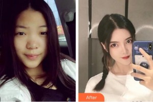 泉州美萊華美整形美容醫(yī)院葉青麗整形價(jià)格表附網(wǎng)紅生態(tài)小翹鼻子案例展示