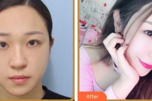 泉州黃氏整形醫(yī)院黃少明整形價(jià)格表附鼻部整形案例展示