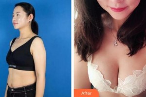 泉州美萊華美整形美容醫(yī)院賈洪仁整形價(jià)格表附胸部案例展示
