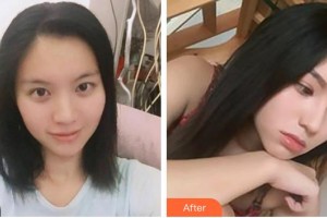 泉州東大整形美容醫(yī)院陳義華整形價(jià)格表附鼻部綜合隆鼻案例展示