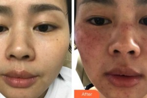 泉州東大整形美容醫(yī)院閔國(guó)榕整形價(jià)格表附祛斑案例展示