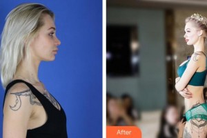 泉州美萊華美整形美容醫(yī)院譚亮整形價(jià)格表附假體隆胸恢復(fù)自然案例展示