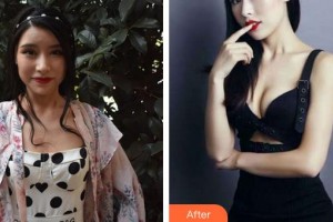 泉州陽(yáng)光純韓整形醫(yī)院張海帆整形價(jià)格表附假體隆胸案例展示