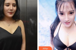 泉州西華醫(yī)療美容醫(yī)院金茶芽整形價(jià)格表附自體脂肪隆胸案例展示