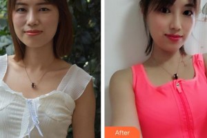 泉州西華醫(yī)療美容醫(yī)院林曉雄整形價(jià)格表附假體隆胸案例展示