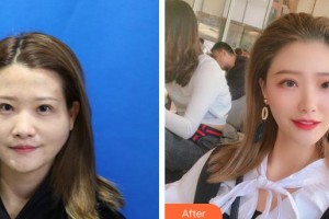 泉州解放軍第180醫(yī)院整形美容中心張如鴻整形價(jià)格表附顴骨顴弓案例展示