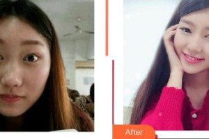 泉州解放軍第180醫(yī)院整形美容中心車麗靜整形價(jià)格表附面部吸脂瘦臉案例展示