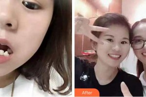 泉州西華醫(yī)療美容醫(yī)院王雪春整形價(jià)格表附牙齒矯正案例展示