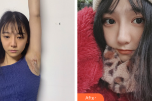 廣州愛來（原阿瑪施）醫(yī)療美容整形醫(yī)院肖大衛(wèi)整形價(jià)格表附腋臭疤痕案例展示