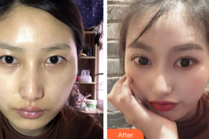 廣州鴻嘉怡美微整形醫(yī)院李靖雯整形價(jià)格表附全切雙眼皮案例展示