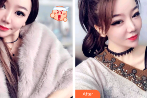 廣州醫(yī)學(xué)院口腔醫(yī)院歐陽可雄整形價(jià)格表附牙齒隱形矯正案例展示