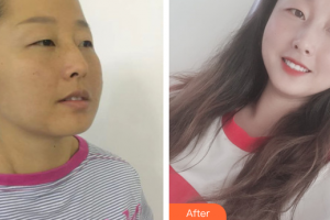 廣州麗尚整形美容門診部李小麗整形價(jià)格表附面部吸脂案例展示