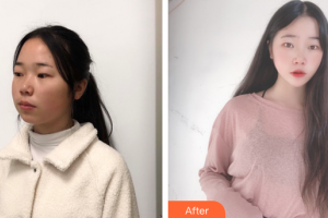 廣州麗尚整形美容門(mén)診部李安琪整形價(jià)格表附面部吸脂案例展示