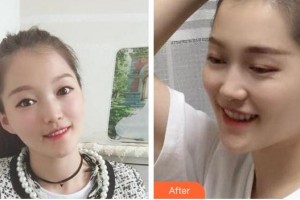 泉州西華醫(yī)療美容醫(yī)院湯麗華整形價(jià)格表附金屬托槽矯正案例展示