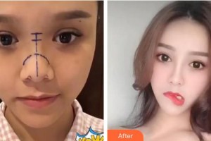 泉州億星醫(yī)療美容門診部李波整形價(jià)格表附隆鼻案例展示