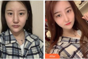 泉州億星醫(yī)療美容門診部李家廣整形價(jià)格表附半肋鼻部手術(shù)案例展示