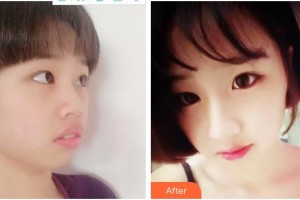 泉州海峽醫(yī)療美容醫(yī)院鄭愛萍整形價(jià)格表附超激光美膚案例展示