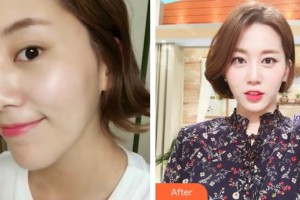 泉州歐菲醫(yī)療美容門診部鄧龍威整形價(jià)格表附超激光美膚案例展示