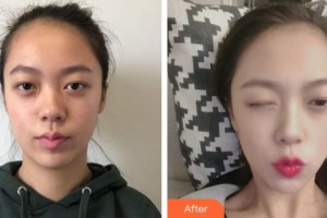 泉州康橋醫(yī)療美容門診部張迪整形價(jià)格表附熱瑪吉案例展示