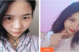 泉州歐菲醫(yī)療美容門診部王偉韜整形價(jià)格表附隆鼻案例展示