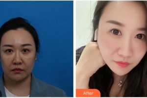 泉州歐菲醫(yī)療美容門診部韓飛整形價(jià)格表附埋線提升案例展示