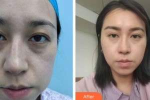 泉州歐菲醫(yī)療美容門診部林婷婷整形價(jià)格表附埋線提升案例展示