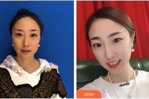 泉州歐菲醫(yī)療美容門診部劉先鋒整形價(jià)格表附多方面部埋線提升案例展示