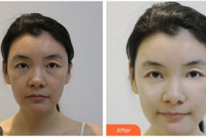 泉州海峽醫(yī)療美容醫(yī)院王秀萍整形價(jià)格表附熱瑪吉（面+頸）-面部緊致案例展示