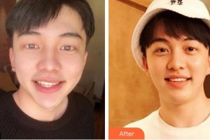 泉州海峽醫(yī)療美容醫(yī)院王嬌嬌整形價(jià)格表附瓷貼面案例展示