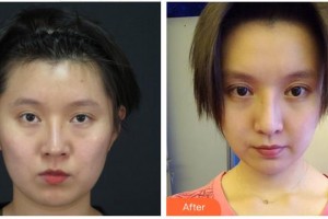 泉州維密醫(yī)療美容門診部夏昂整形價(jià)格表附重瞼修復(fù)+開內(nèi)眥案例展示