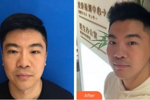 泉州維密醫(yī)療美容門診部林楦整形價(jià)格表附埋線提升案例展示