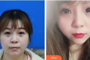 泉州美萊華美醫(yī)療美容門診部鐘豪整形價(jià)格表附埋線提升案例展示