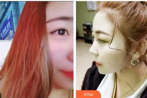 泉州泉興口腔門診部惠雯婷整形價格表附超聲波潔牙案例展示