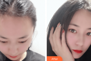 廣州雍禾植發(fā)門(mén)診部馬中林整形價(jià)格表附發(fā)際線種植案例展示