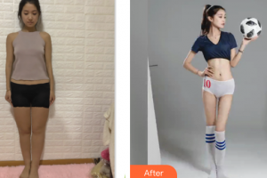 廣州法思脂肪移植醫(yī)學(xué)美容醫(yī)院李越整形價(jià)格表附腰腹環(huán)吸+大小腿吸脂案例展示