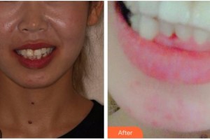 泉州貝臣口腔門診部吳東良整形價格表附瓷貼面案例展示