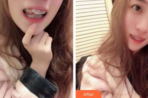 泉州貝臣口腔門診部張英整形價格表附牙齒矯正案例展示