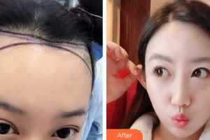 廣州雍禾植發(fā)門(mén)診部王傳凱整形價(jià)格表附發(fā)際線種植案例展示