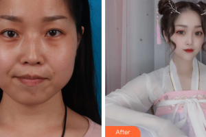 廣州壹加壹美容醫(yī)院甘泉涌整形價(jià)格表附下頜角+下頦前移案例展示