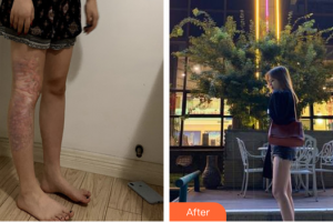 廣州國(guó)姿醫(yī)療美容整形醫(yī)院盧艷整形價(jià)格表附增生疤痕案例展示