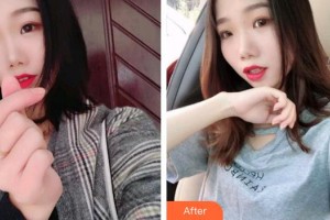 泉州維樂口腔門診部董龍福整形價格表附超聲波潔牙案例展示