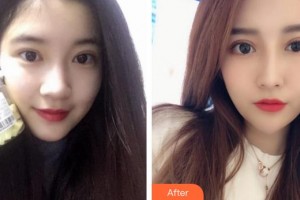 泉州愛爾眼科醫(yī)院呂帆整形價格表附眼部手術(shù)案例展示