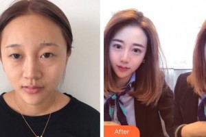 泉州愛爾眼科醫(yī)院李曉霞整形價格表附眼部綜合案例展示