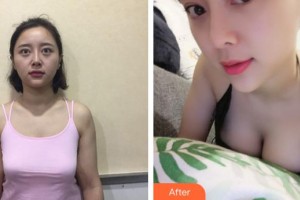 泉州脂管加醫(yī)療美容門診部吳雪玉整形價格表附隆胸案例展示