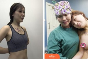 泉州脂管加醫(yī)療美容門診部楊杰整形價格表附自體脂肪隆胸案例展示