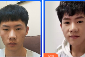 廣州博仕整形美容醫(yī)院劉洋整形價(jià)格表附切開(kāi)雙眼皮案例展示